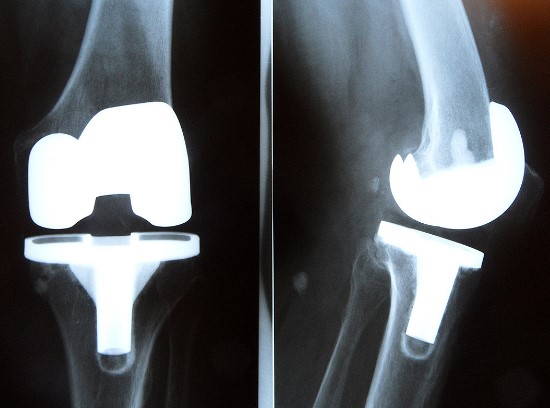 gonartroza solutii articulația genunchiului doare mult timp