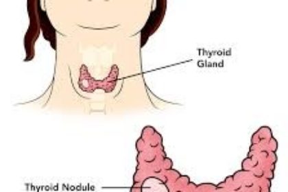 Nodulul tiroidian | Crisdent Clinic