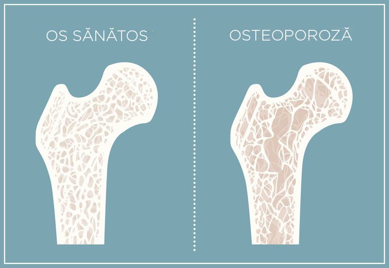 pierderea în greutate osteoporoză